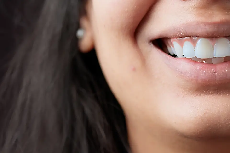 Common Questions about Teeth Whitening