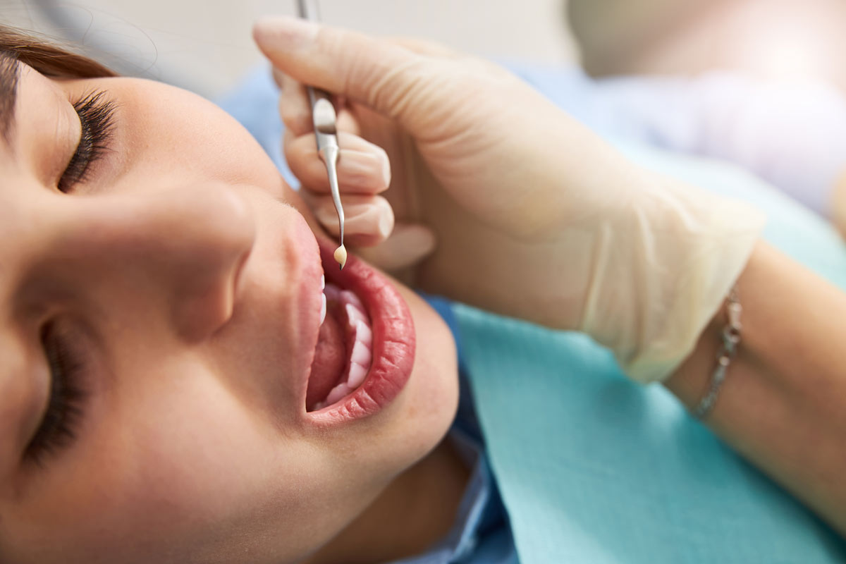 Affordable Dental Filling in Richmond Hill, Toronto