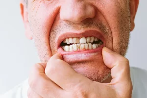 What Is Gum Disease?
