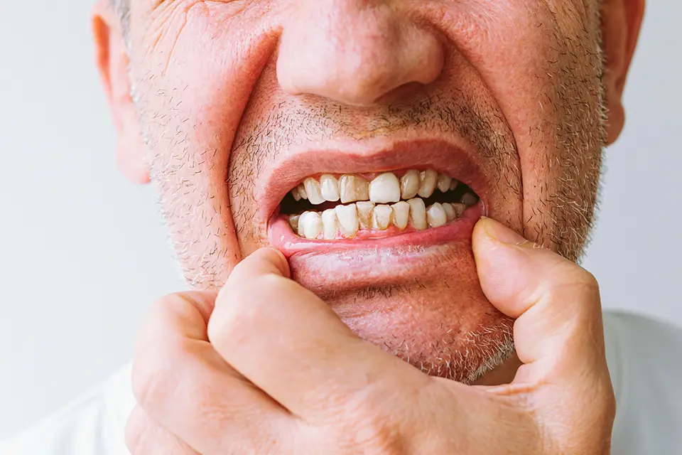 What Is Gum Disease?