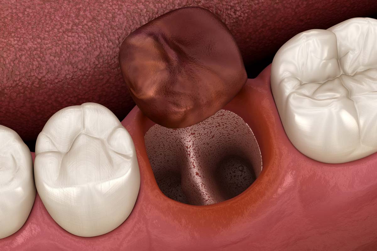 Dry Socket Prevention and Treatment After Tooth Extraction