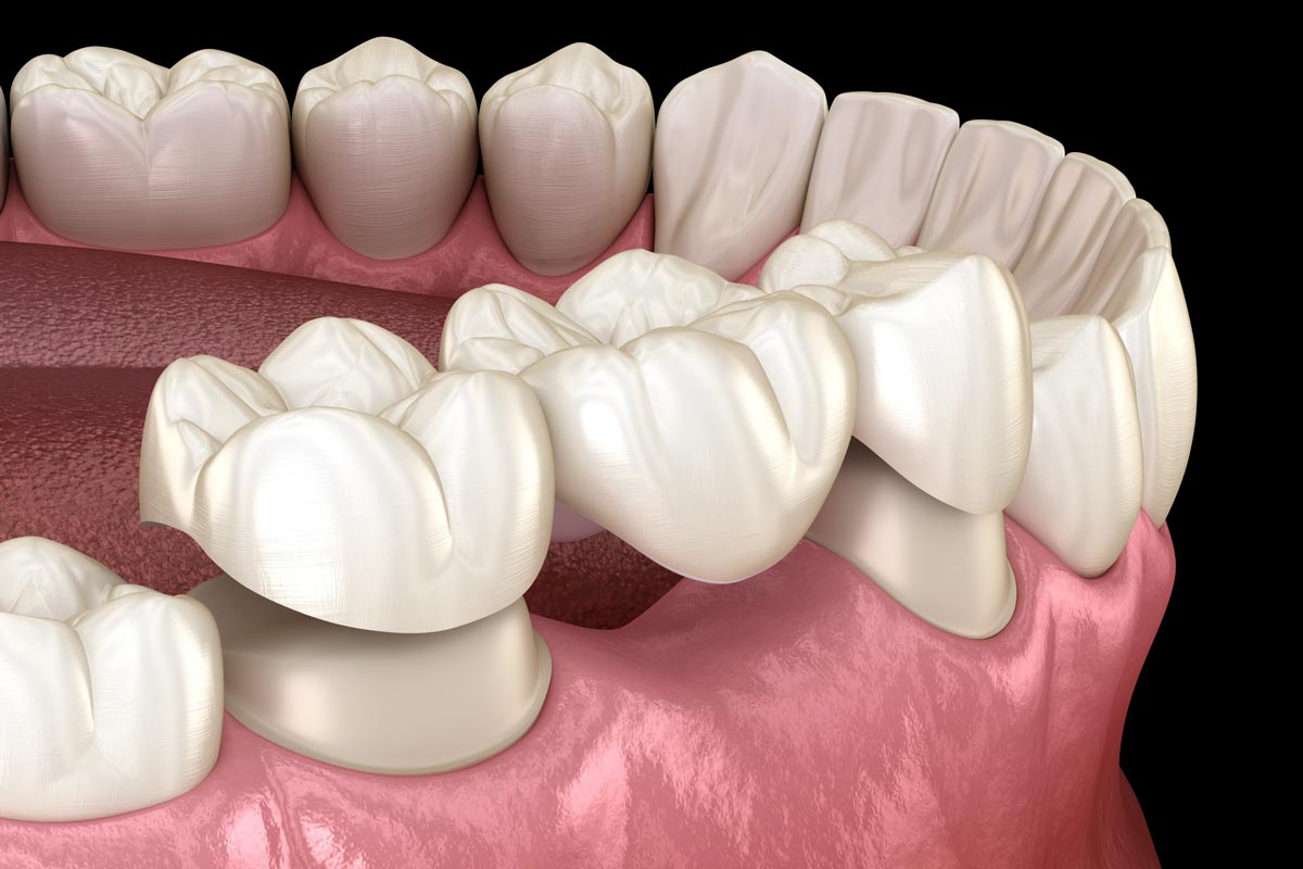 Dental Bridges - Smile Dental - St. Clair, Toronto - (647) 483 4147