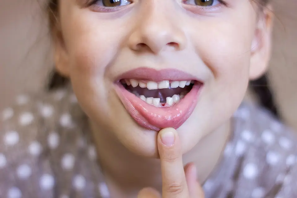 5 Tips to Handle a Loose Tooth for Parents and Children