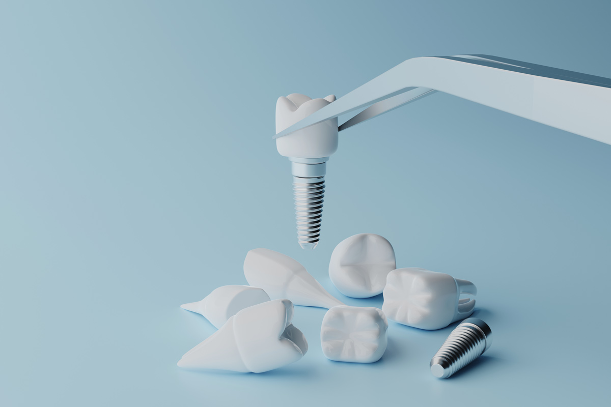 Choosing The Right Tooth Replacement: A Comparison of Dental Implants And Other Options