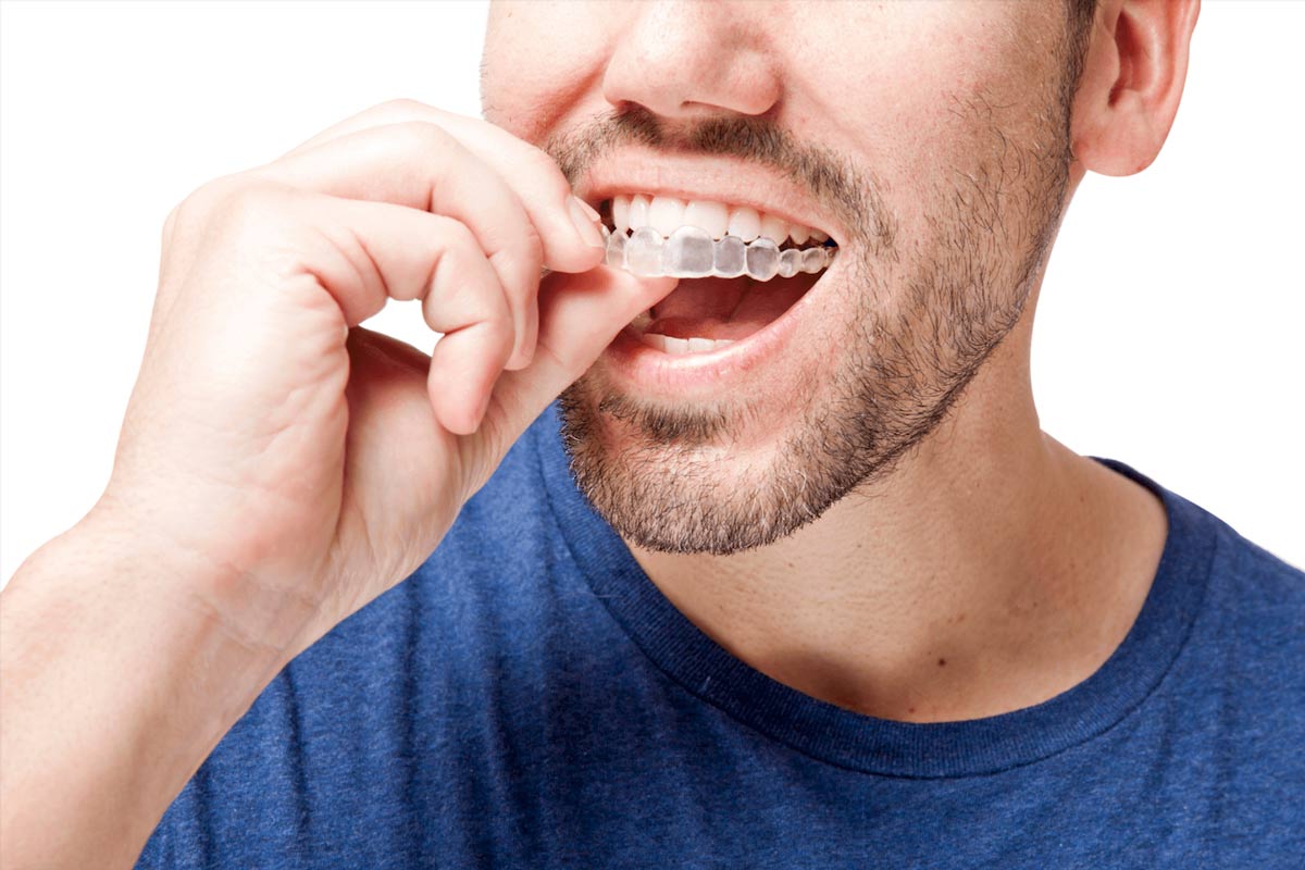 Affordable Invisalign Aligners in St. Clair, Toronto