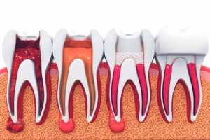 Affordable Root Canal Therapy in Toronto