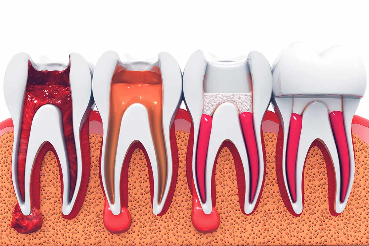 Affordable Root Canal Therapy in Toronto