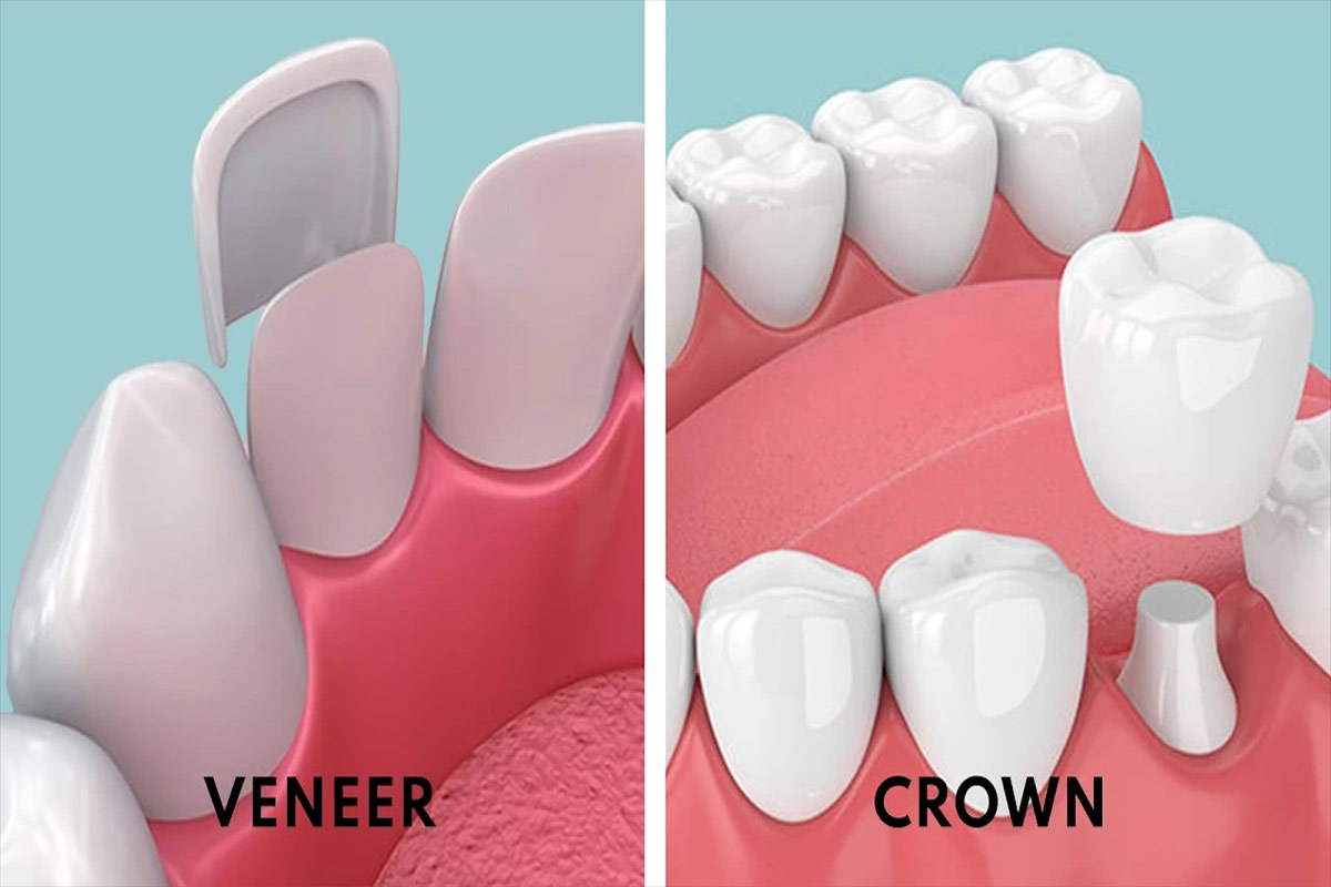 Affordable Veneers or Crowns in St. Clair, Toronto