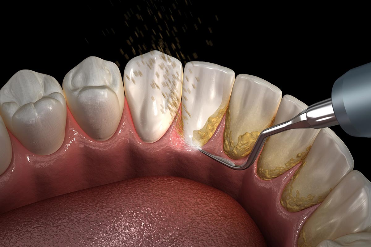 The Crucial Impact of Skipping Dental Cleanings