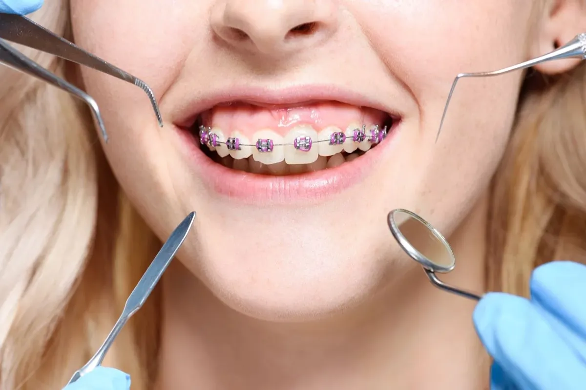 Affordable Orthodontic Treatments in St. Clair, Toronto