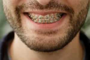 Affordable Braces in St. Clair, Toronto