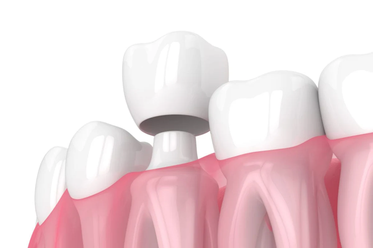 Affordable Dental Crown in St. Clair, Toronto