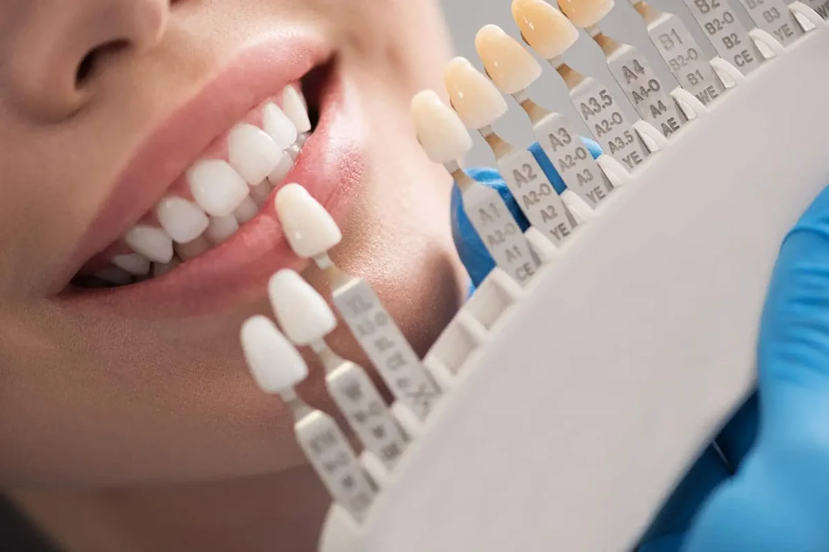 Can I Whiten Dental Crowns?