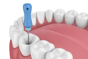 The Cost of Root Canal Therapy in Toronto