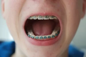 Embracing Change: A Guide to Life with Braces at Smile Dental in St. Clair, Toronto