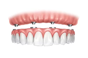 Affordable Full Mouth Implants in St. Clair, Toronto