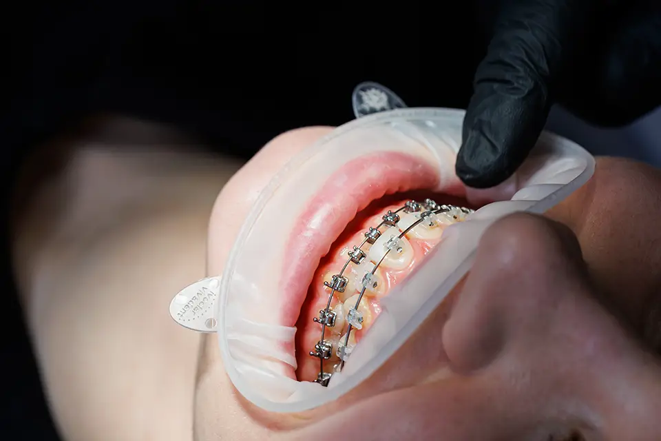 When Is the Right Time for Orthodontic Treatment?