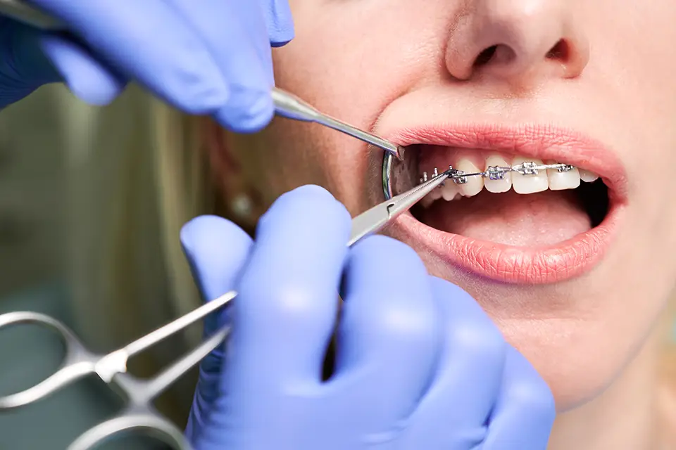 Tooth Extraction and Orthodontics: Achieving Perfect Bite Alignment at Smile Dental, St. Clair, Toronto