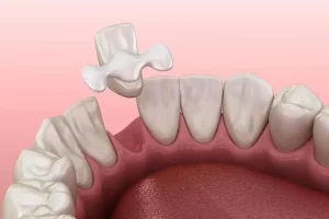 Considerations in Front Teeth Restoration with Dental Bridges