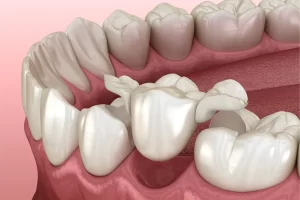 Single-Tooth Replacement: Restoring Your Smile with Dental Bridges