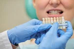 Replacing Front Teeth with Dental Bridges: Achieving Aesthetic Excellence at Smile Dental in St. Clair, Toronto