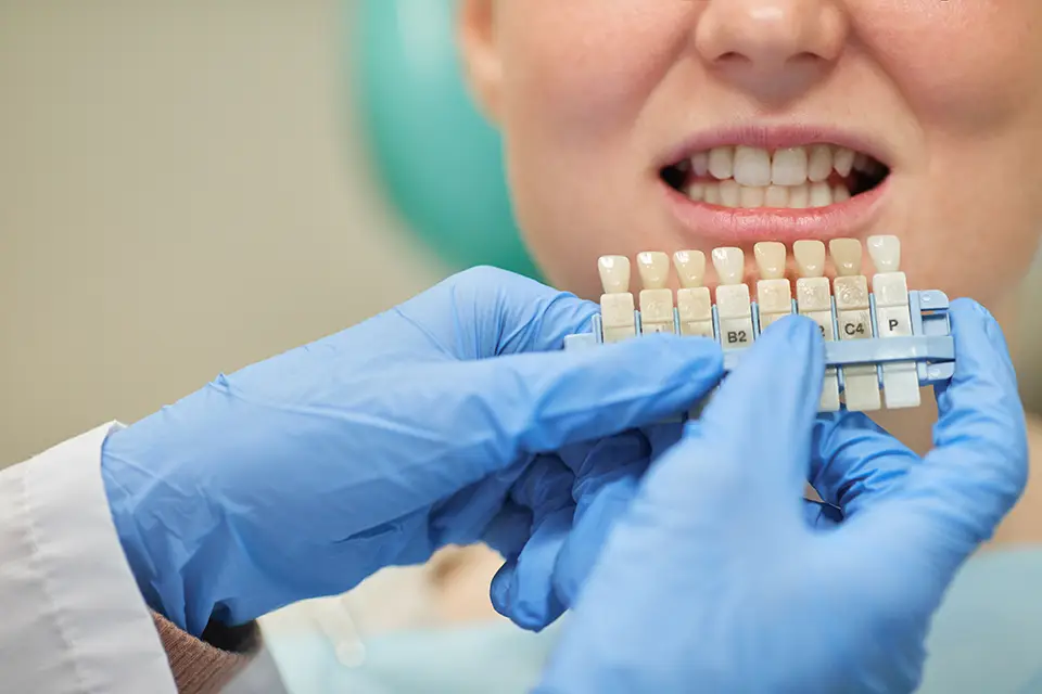 Replacing Front Teeth with Dental Bridges: Achieving Aesthetic Excellence at Smile Dental in St. Clair, Toronto