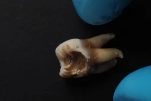 Impacted Wisdom Teeth: Understanding the Basics