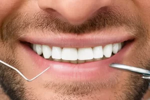 Dental Bonding Vs Veneers: Smile Makeover Solutions