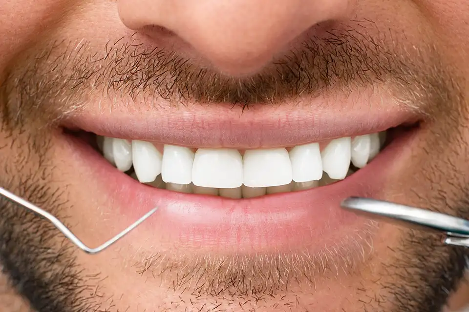 Dental Bonding Vs Veneers: Smile Makeover Solutions