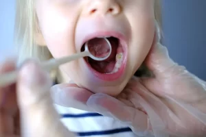 Cavities In Baby Teeth