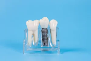 Dental Implants Recovery Time