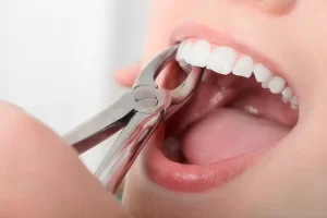 The Tooth Extraction Procedure