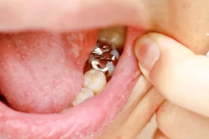Maintenance and Care for Dental Fillings: Essential Tips for a Healthy Smile
