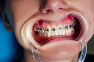 Average Time for Orthodontic Treatment: What to Expect