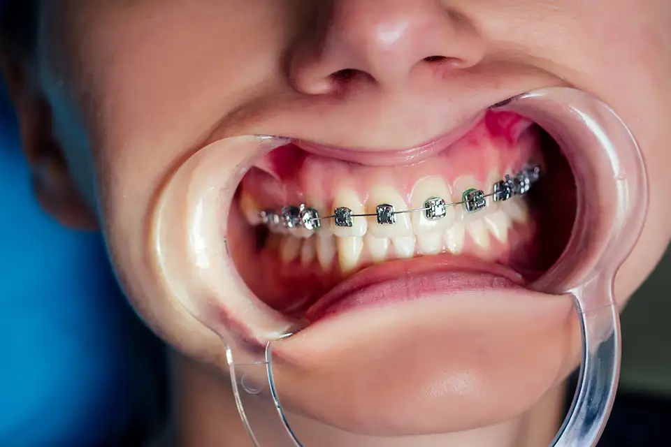 Average Time for Orthodontic Treatment: What to Expect
