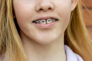 Risks and Complications of Orthodontics: A Guide for Patients