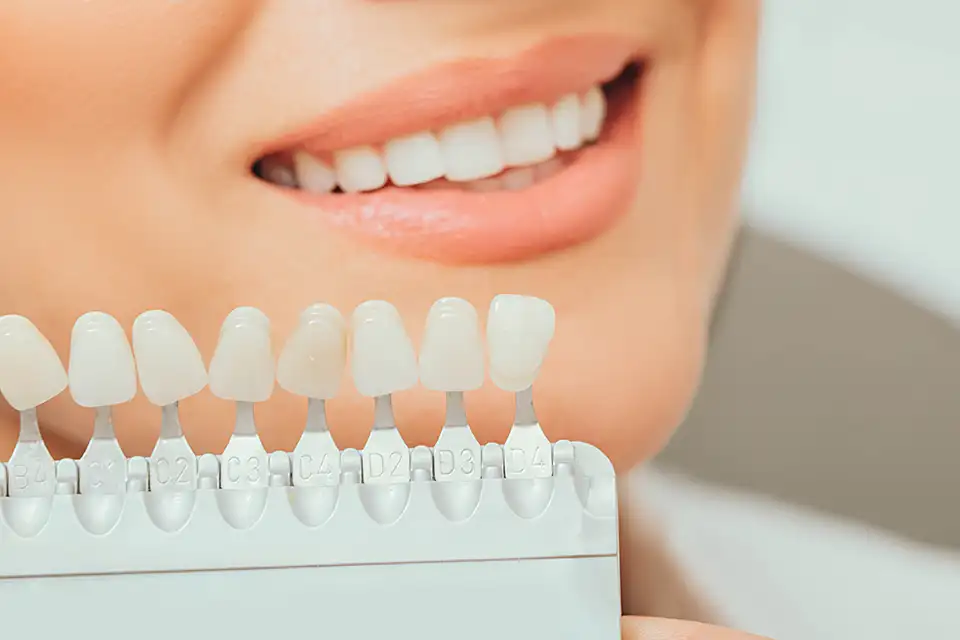 Dental Veneers vs. Crowns: Choosing the Best Option for Your Smile