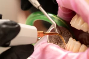 Plaque Removal Techniques: A Complete Guide