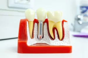 Alternative to Dental Implants