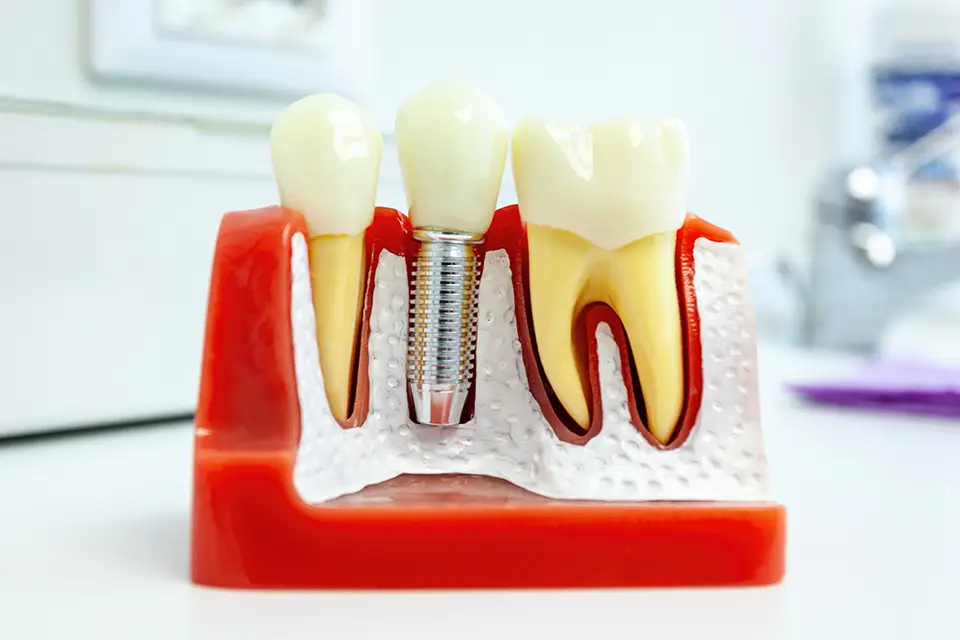 Alternative to Dental Implants