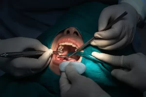 Oral Surgery for Wisdom Teeth Extraction
