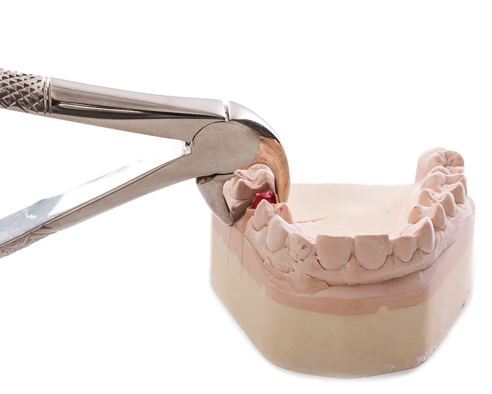 Dental Extraction in Toronto