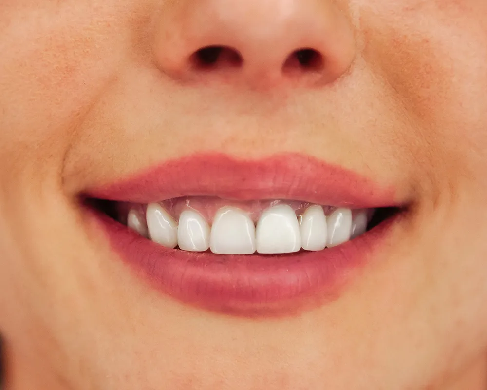 Best Dental Veneers Toronto