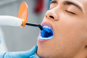 Understanding Teeth Whitening Durability: What You Need to Know