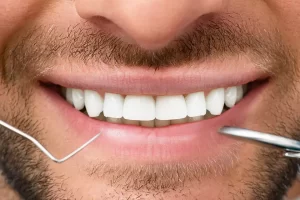 Understanding the Difference Between Veneers and Composite Bonding