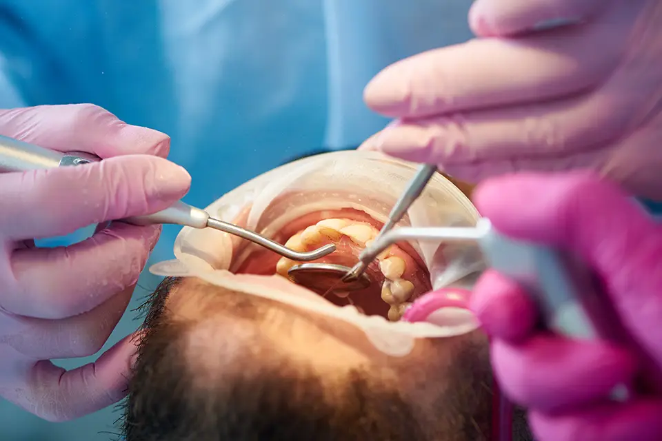 Alternative Treatments to Root Canal: What You Should Know