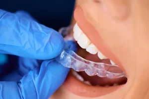 Invisalign Cost Toronto: What You Need to Know Before Starting Treatment