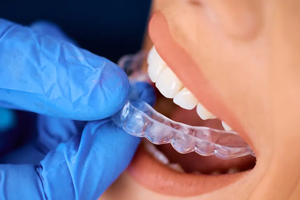 Invisalign Cost Toronto: What You Need to Know Before Starting Treatment