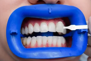 Zoom Teeth Whitening Toronto: A Clear, Comfortable Path to a Brighter Smile