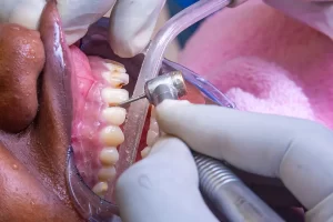 Deep Cleaning Teeth for Sensitive Gums Toronto: A Calm, Step-By-Step Guide